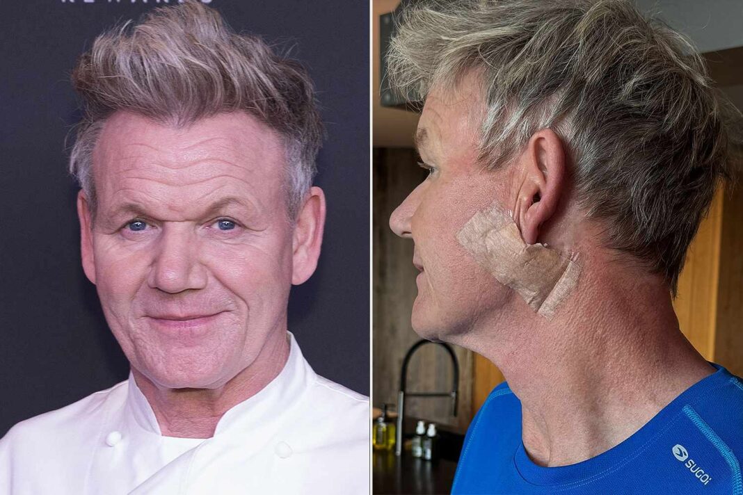 Gordon Ramsay Reveals Skin Cancer Battle, Urges Public to Prioritize Sunscreen After Surgery
